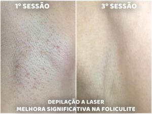 depilacao_laser1