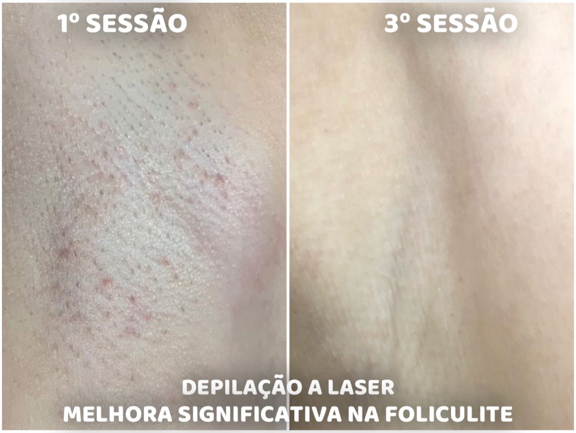 Depilação A Laser Urbano Laser