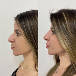 harmonização-facial