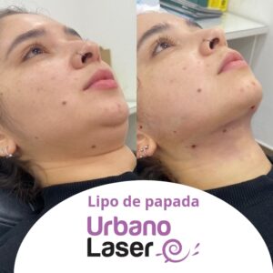 lipo_papada1