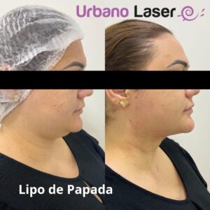 lipo_papada4